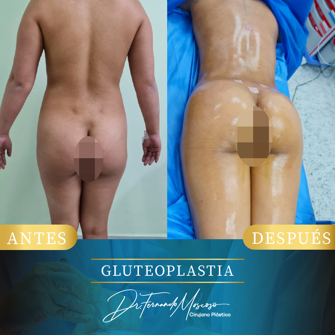 Gluteoplastia1