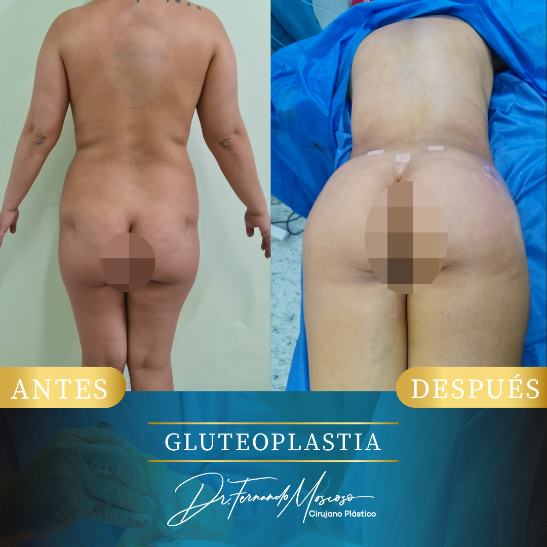 Gluteoplastia2