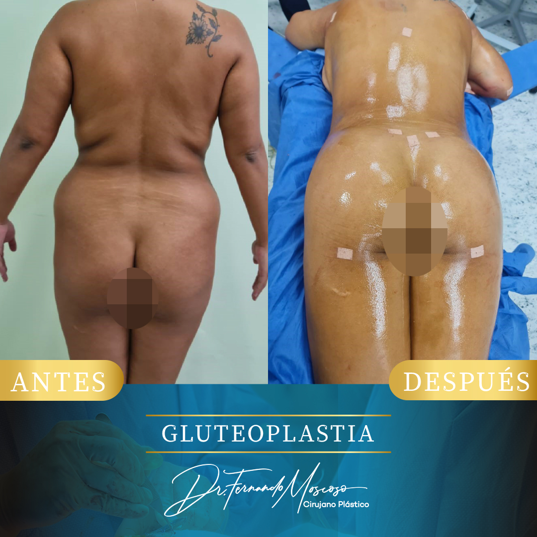 Gluteoplastia3
