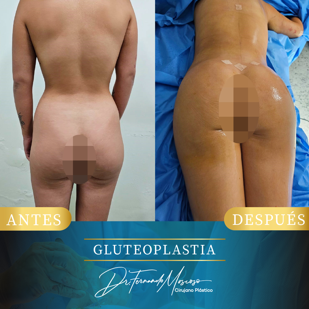 Gluteoplastia4