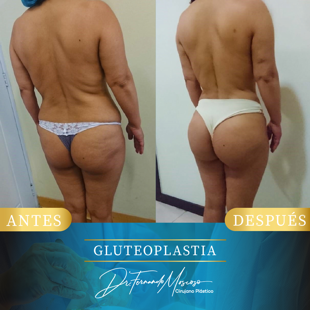 Gluteoplastia5