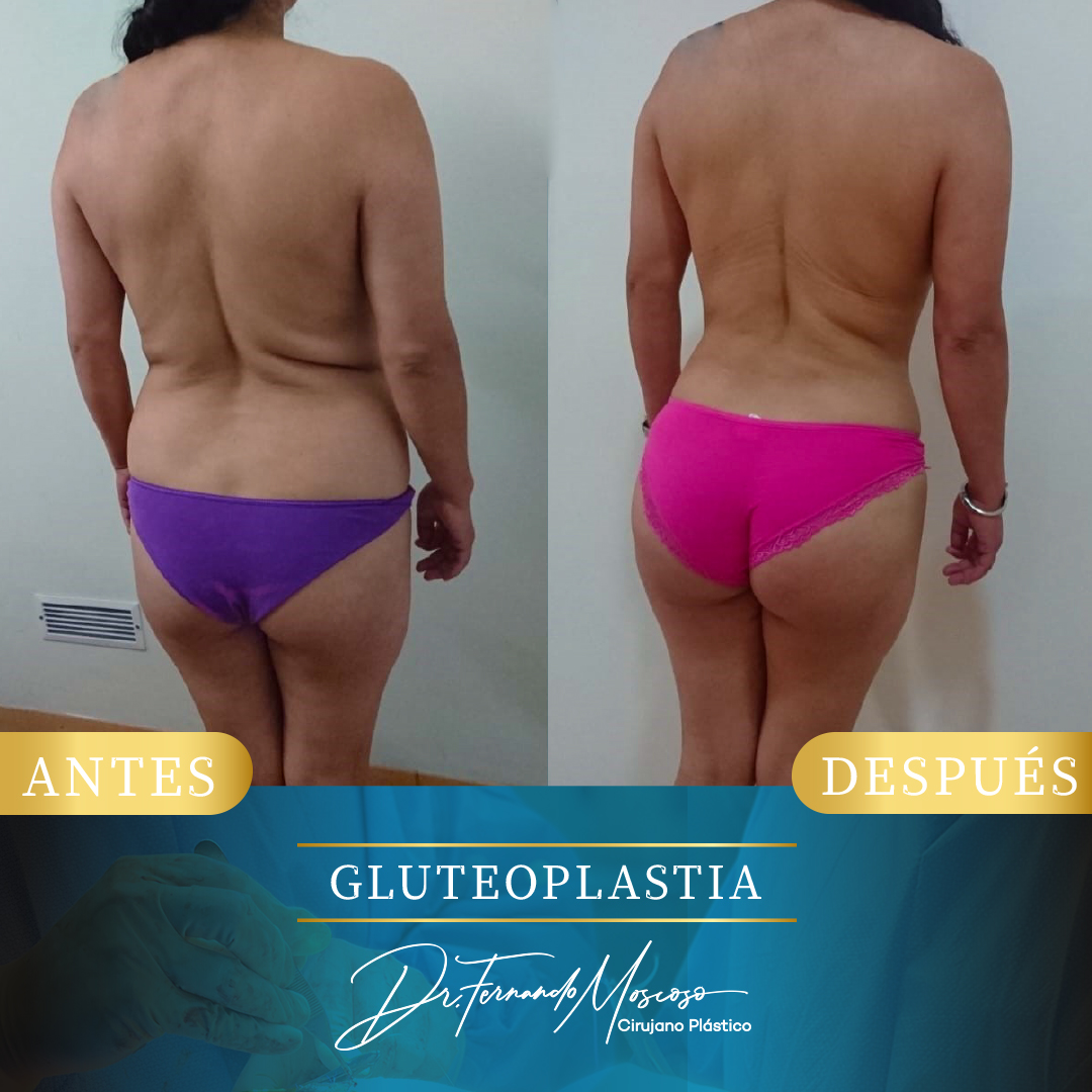Gluteoplastia7