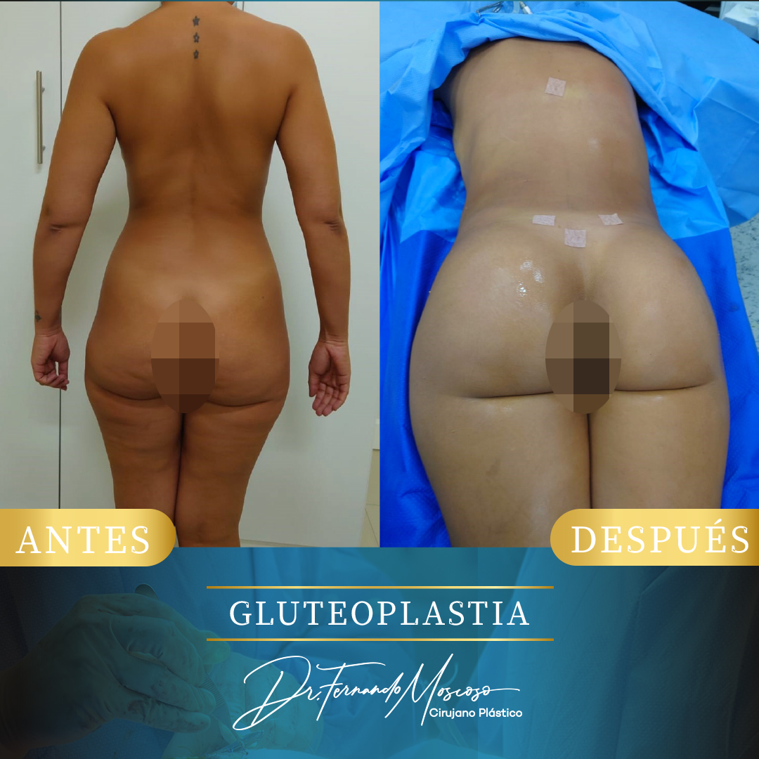 Gluteoplastia8